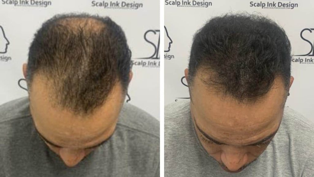 HAIR-DENSITY-1024x576.jpg